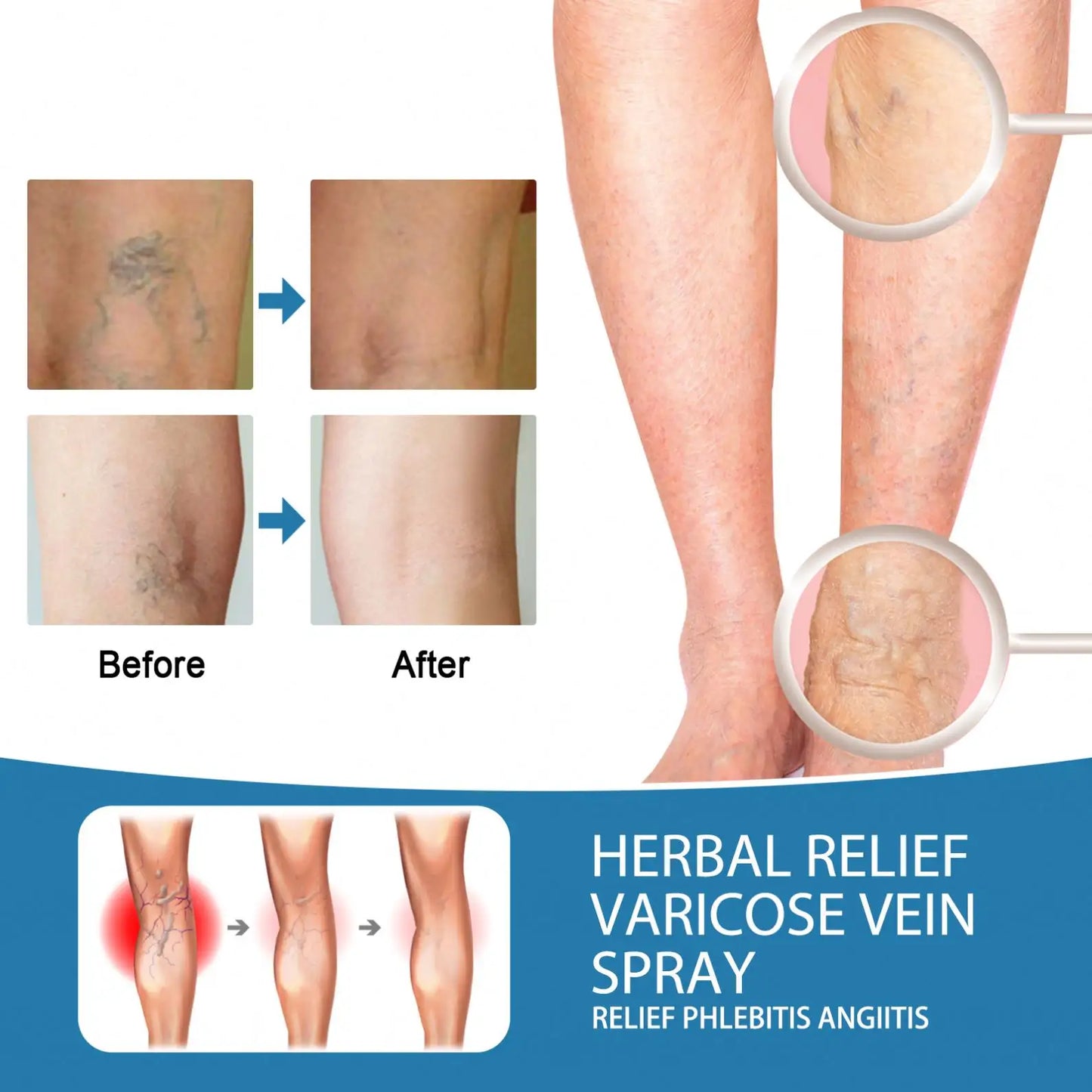 Herbal Relief Varicose Veins Spray