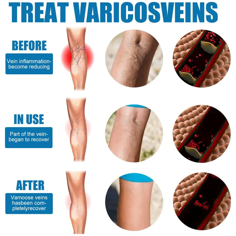 Herbal Relief Varicose Veins Spray